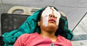 शिक्षक आन्दोलनमा घाइते भएकी पत्रकार सविना कार्कीको आँखामा समस्या